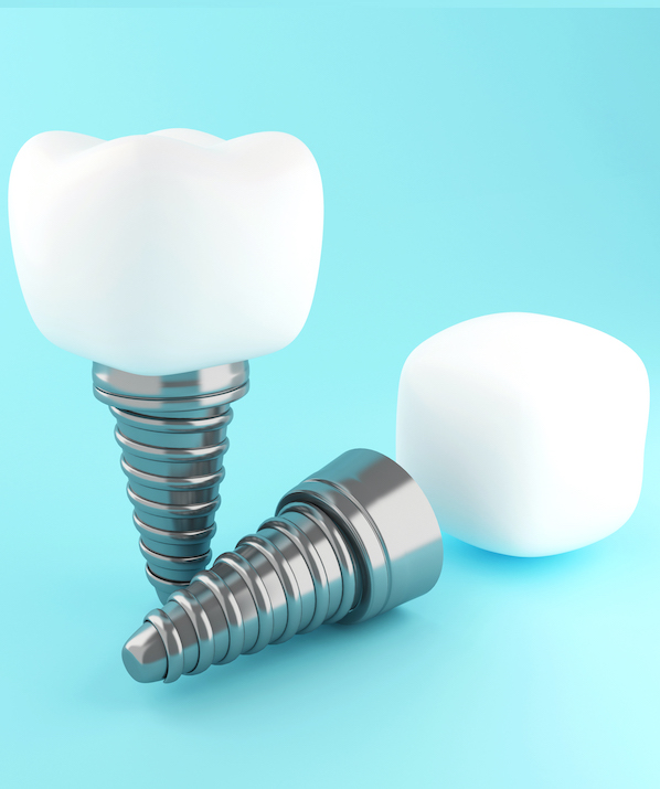 best dental implants