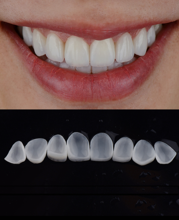 Teeth Whitening Singapore