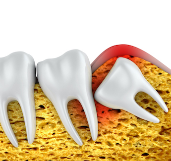 Toothache Molar Singapore