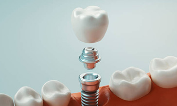 Dental-Implants-feature